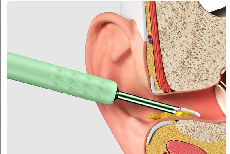 Limpador de Ouvido Com Câmera e Iluminação